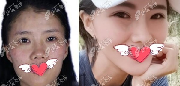刘冰院长肋骨鼻综合术前和术后3个月变化图