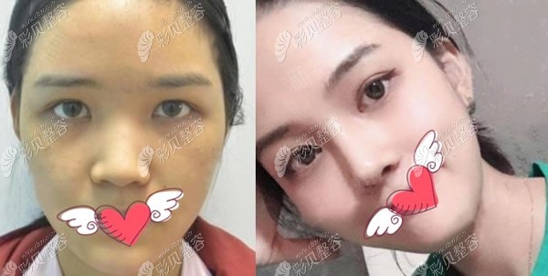 鲁班鼻综合术前和术后1个月对比照