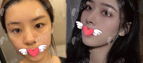 刘冰医生鲁班鼻综合术前和术后半年变化过程图