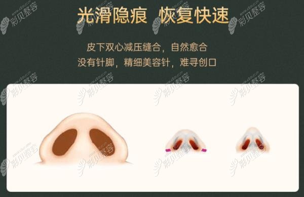 皮下双心减压缝合过程图