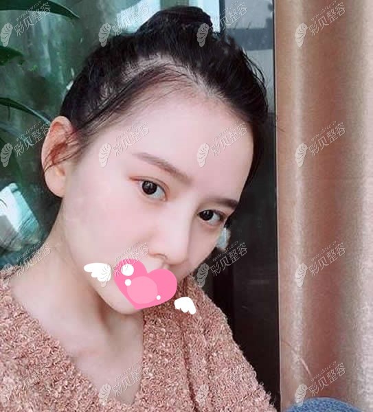 郑州美莱周蔚做的鼻修复手术7天拆线了