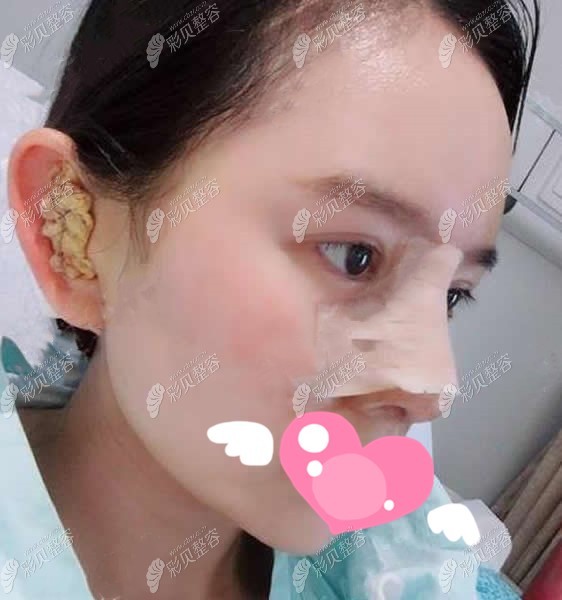 周蔚医生肋骨鼻修复术后第5天效果图