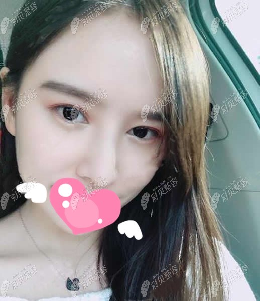 在郑州美莱做鼻修复手术后1年恢复照片