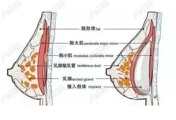 假体放入位置