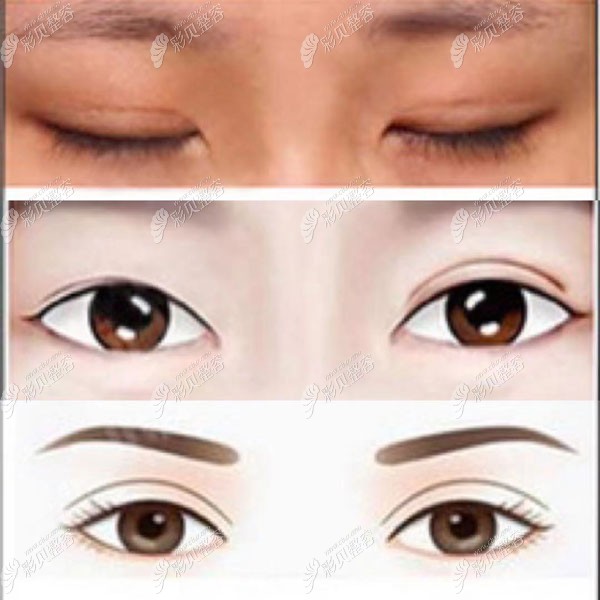 哪些眼睛需要修复