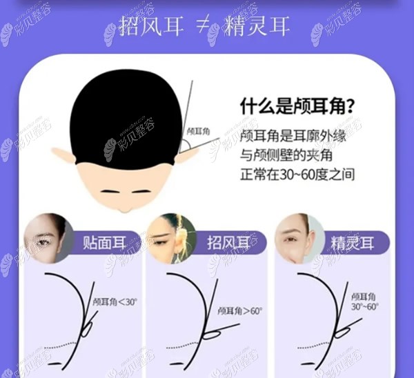 贴发耳、精灵耳和招风耳的区别图片