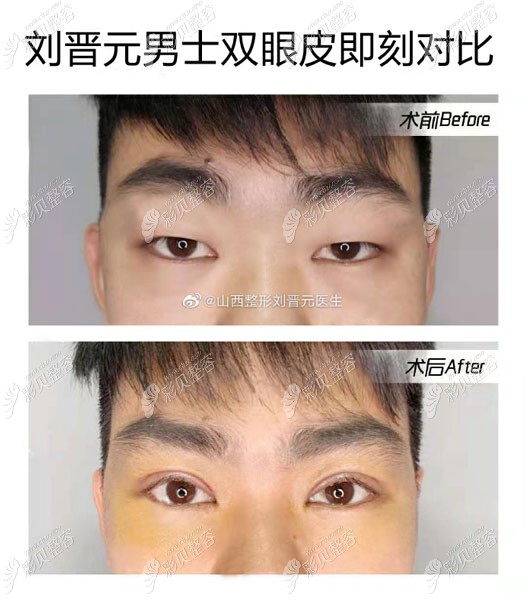 刘晋元医生拉双眼皮 刘晋元医生拉双眼皮