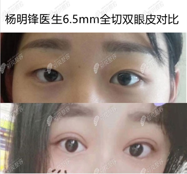 杨明锋割双眼皮对比 杨明锋割双眼皮对比