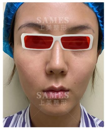 我人中长15mm在北京做了人中缩短手术，分享90天的对比照片