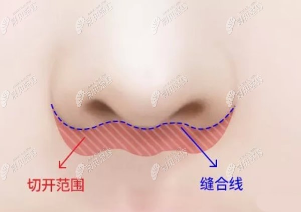 人中缩短术都是大疤痕吗 人中缩短术都是大疤痕吗