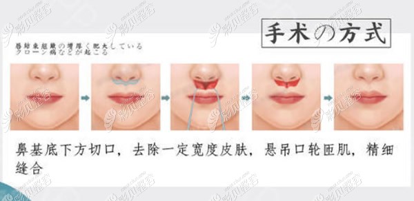 人中缩短手术操作流程 人中缩短手术操作流程