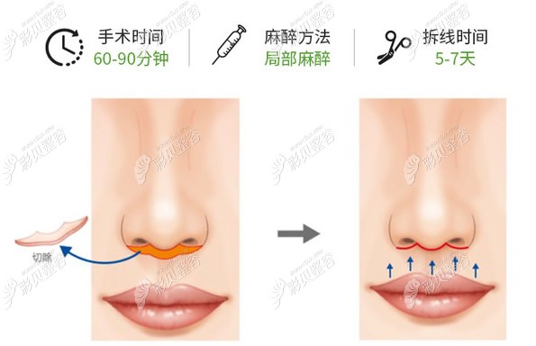 我人中长15mm在北京做了人中缩短手术,分享90天的对比照片 - 整形日记