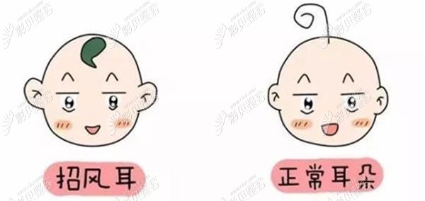 小孩的招风耳