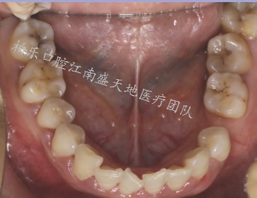 南宁种植牙多少钱一颗？我做的是诺贝尔pcc种植牙，价格13980