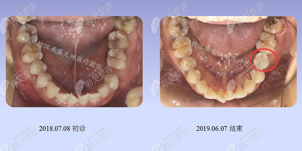 南宁柏乐口腔种植牙前后对比照片