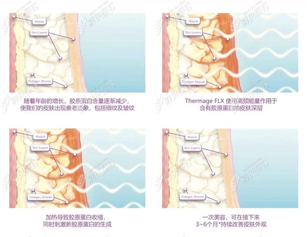热玛吉美容原理