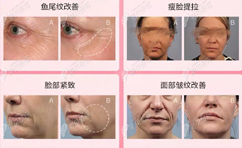 热玛吉美容效果