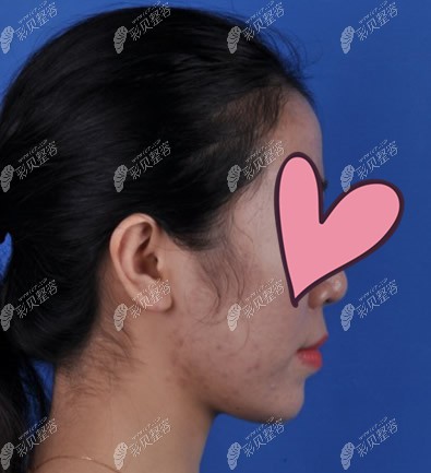 舌侧矫正前侧脸照