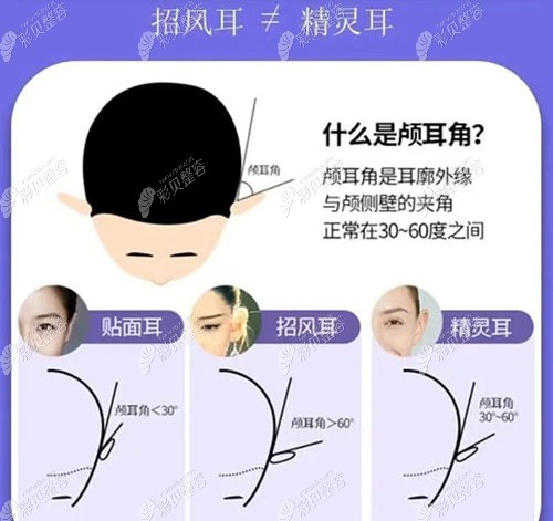 贴面耳、招风耳、精灵耳的区别 贴面耳、招风耳、精灵耳的区别