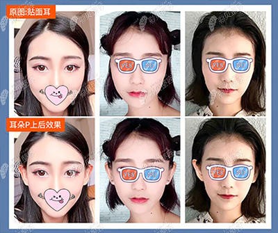 贴面耳和精灵耳对比图 贴面耳和精灵耳对比图