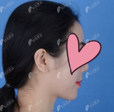 南宁柏乐口腔舌侧矫正5个月效果怎么样