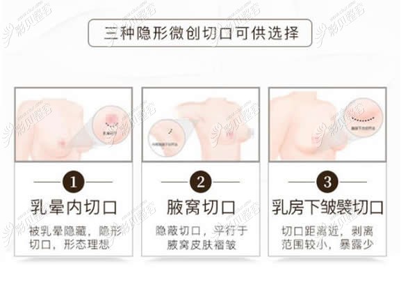 隆胸的三种切口