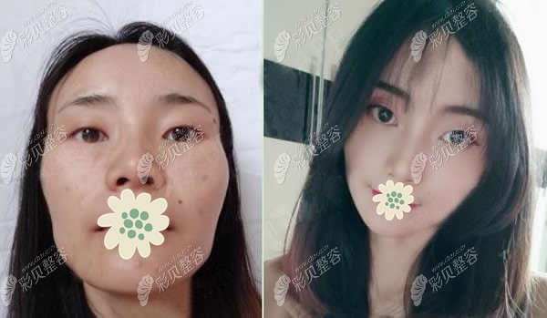 北京艺星全脸脂肪填充术前和术后20天效果对比