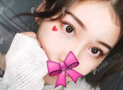 兰州崔大夫师芸红做双眼皮