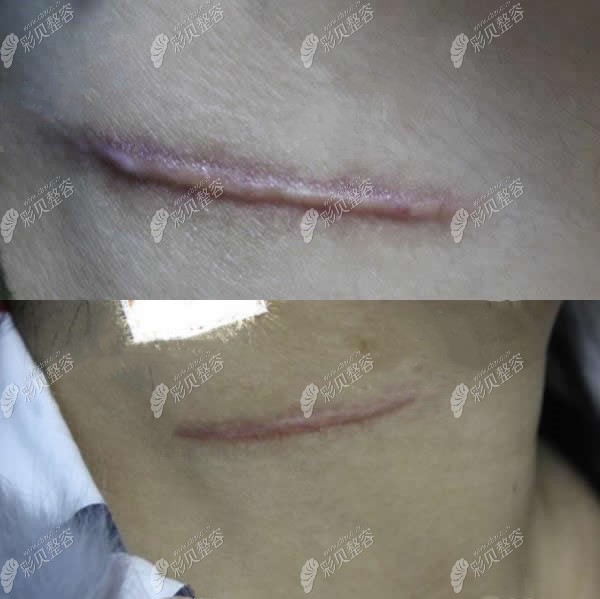 在保定华仁做两次染料激光治疗疤痕增生的恢复过程图