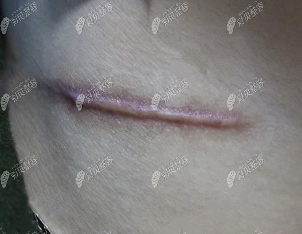 在保定华仁做两次染料激光治疗疤痕增生的恢复过程图