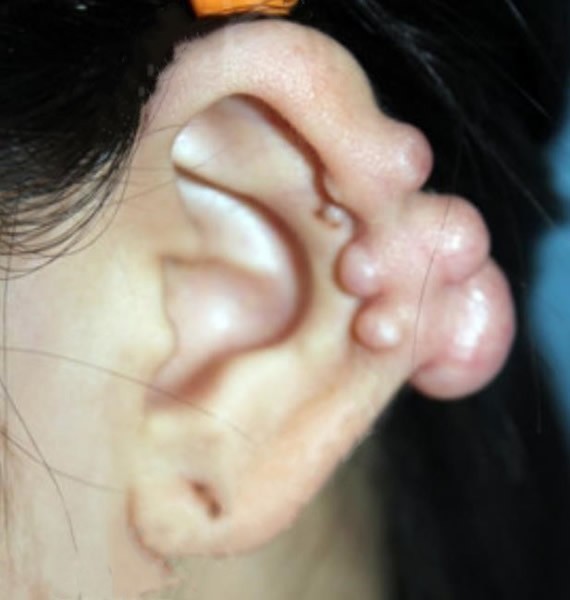 去上海修复耳洞疤痕疙瘩的手术全过程及治疗前后对比图