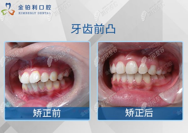刘文波医生牙齿前凸矫正病例