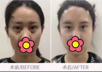 荆州庞春典医生全脸脂肪胶填充价格是3万多，效果挺自然的