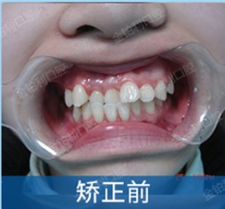 成年人地包天+牙齿拥挤矫正前后对比照,嘉兴金铂利口腔做的