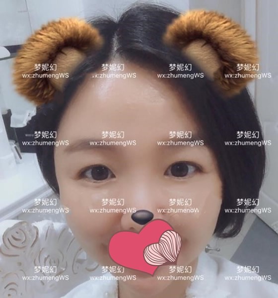 32岁去海南曙光梦妮幻做眼综合，改善了我的眼皮松弛下垂