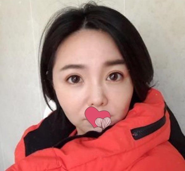 32岁去海南曙光梦妮幻做眼综合，改善了我的眼皮松弛下垂