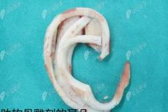 ​北京煤医耳畸形矫正修复中心做耳再造的费用大概多少钱