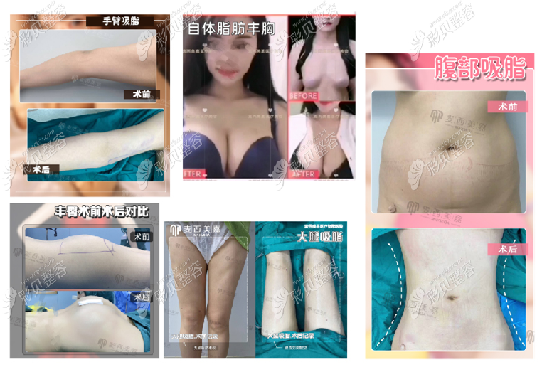 吉林长春麦西美嘉医疗美容门诊部吸脂手术效果