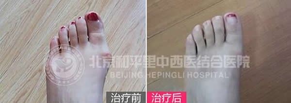矫正大脚骨亲身经历：做微创拇外翻术后三个月走路不疼了