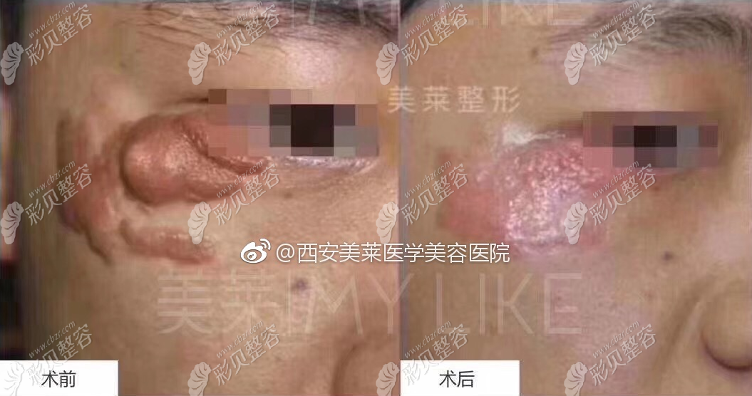 西安美莱整形治疗疤痕疙瘩效果对比图 西安美莱整形治疗疤痕疙瘩效果对比图