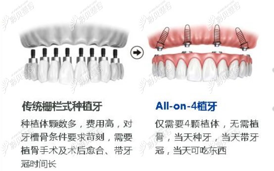 All-on-4种植牙与传统种植牙区别
