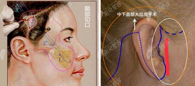 沈阳名流拉皮提升面部手术，给你注射去除法令纹的第2选择