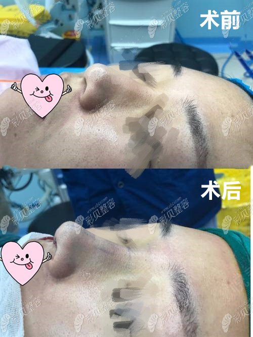 武汉艺星整形杨斐医生做鼻子图片