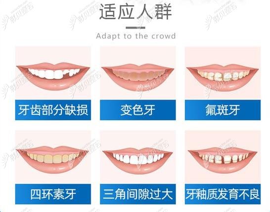 牙齿美学修复适应人群