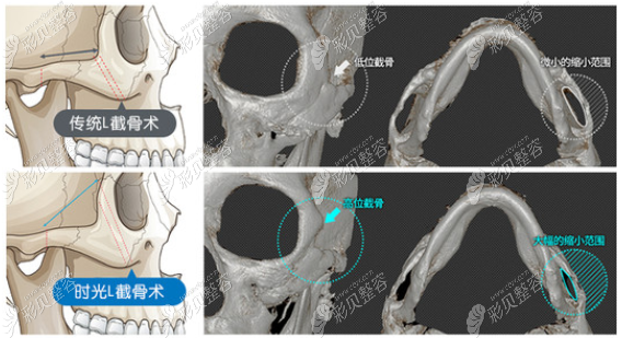 传统L截骨手术VS颧骨3D旋转缩小术