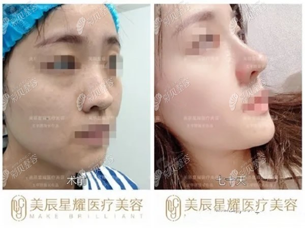 硅胶隆鼻后鼻头挛缩的小姐姐找王宇琨医生做了膨体加耳软骨鼻修复后的图片