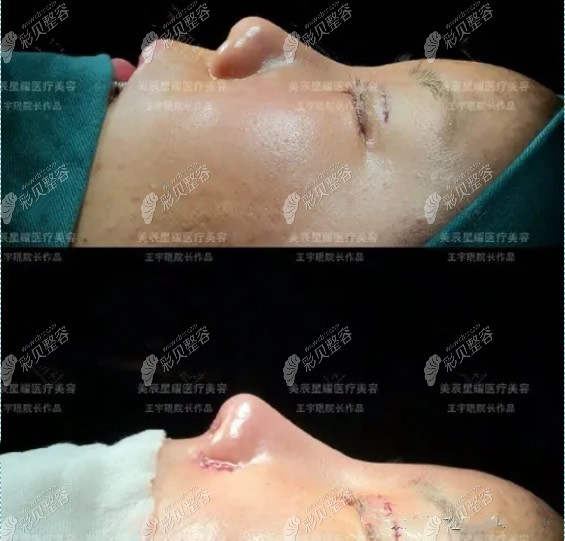 王宇琨医生全切双眼皮和肋鼻骨综合前后对比照片