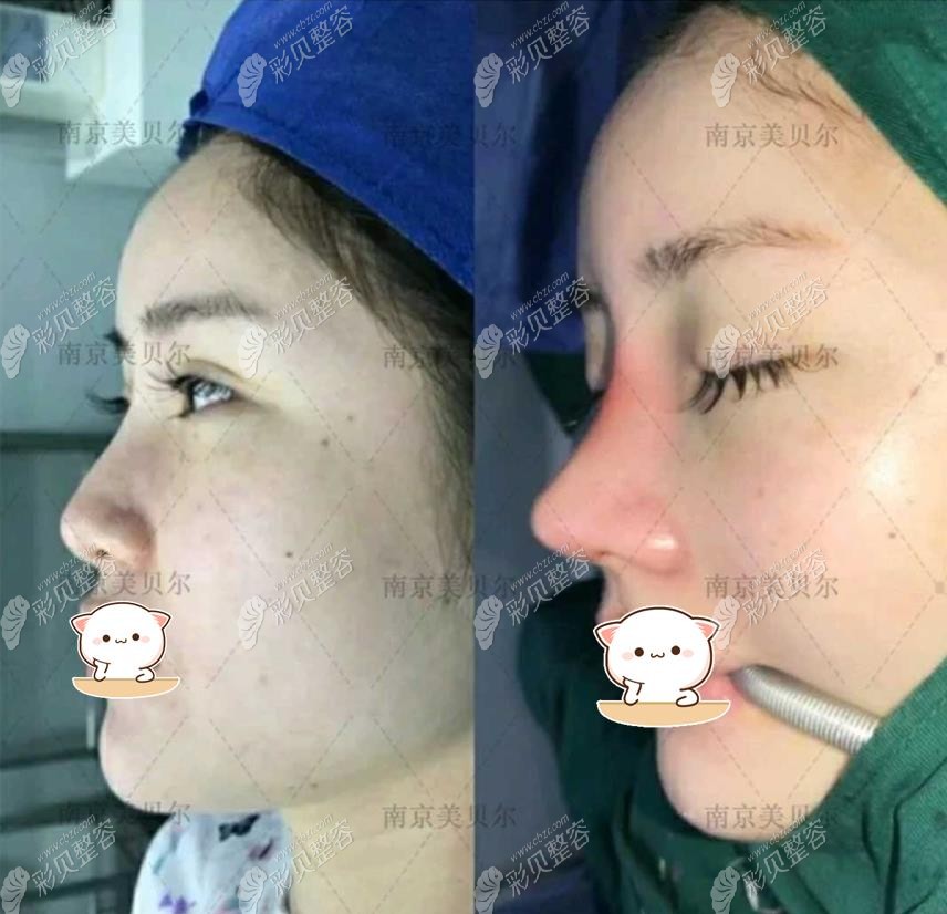 南京美贝尔隆鼻术前与术后即刻效果对比图