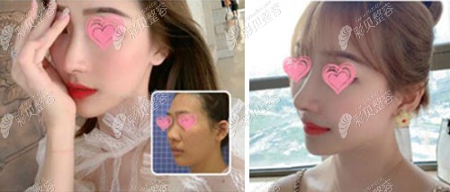 南京隆鼻好的医院推荐:前十家是南京鼻综合手术有名的医院