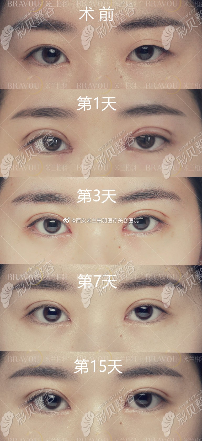 西安米兰柏羽美杜莎眼综合真人例子 西安米兰柏羽美杜莎眼综合真人例子